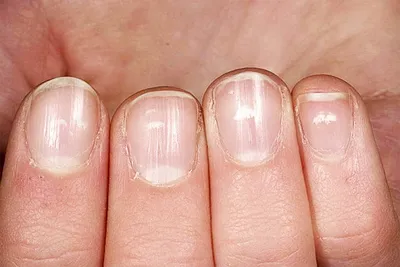 Авитаминоз весны ногтей стоковое изображение. изображение насчитывающей  заболевания - 134936107