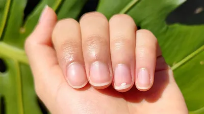 Галина Ежова - Онихолизис — это изменения ногтя, в результате которого  ногтевая пластина отходит от ногтевого ложа. Существует достаточно много  причин для развития данной патологии, например, авитаминоз, использование  некачественных лаков, травмы ногтей,