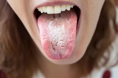 Бактерии из полости рта | Пикабу