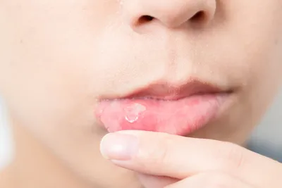 Чем питаются микробы во рту? — Андрей Делендик — дантист