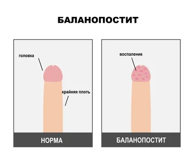 Баланит и Баланопостит ≡ лечение и препараты для лечения баланита - МИС  Аптека 9-1-1