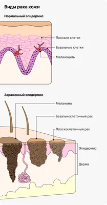 Лечение рака кожи в Киеве - цены и отзывы в клинике Оксфорд Медикал