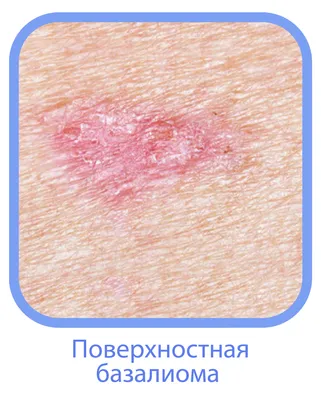 Базальноклеточный рак кожи (базалиома) | Клиника АЛОДЕРМ , Москва