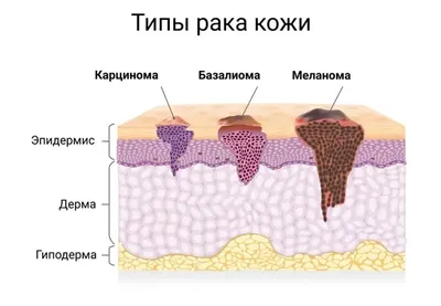 Лечение плоскоклеточного рака кожи