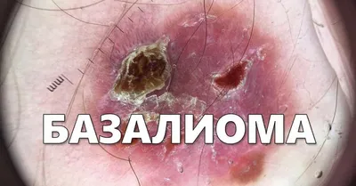Базальноклеточный рак кожи (базалиома) | Клиника АЛОДЕРМ , Москва