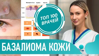 Удаление базалиомы (базальноклеточного рака) в клинике инновационных  медицинских технологий