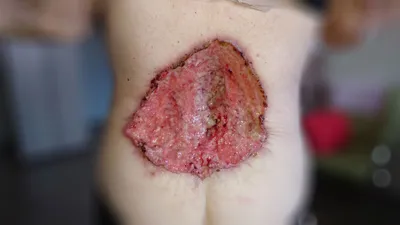 Как выглядит БАЗАЛИОМА (фото 1-7). Базальноклеточный рак кожи.  Базальноклеточная карцинома - YouTube