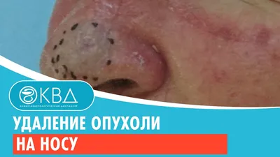 REVIEWS Новообразования наружного носа The external nose neoplasms