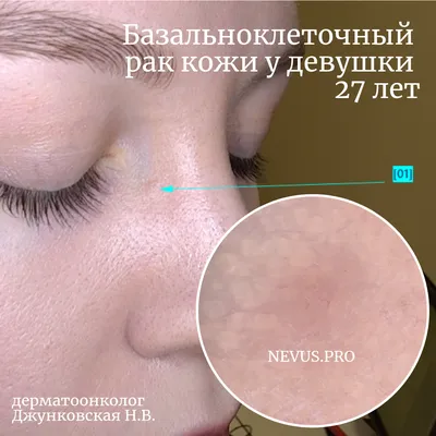 Рак кожи на кончике носа — базальноклеточная карцинома — nevus.pro