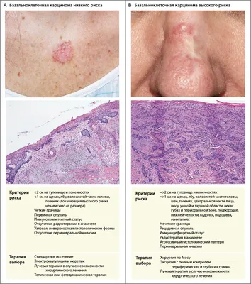 Базальноклеточная карцинома или доброкачественный невус? | Меланома Юнит  СПб | Дзен