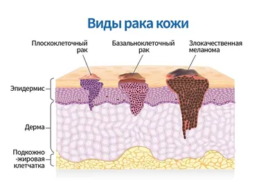 Giant nodular basal cell skin cancer - Sedova - Vestnik dermatologii i  venerologii