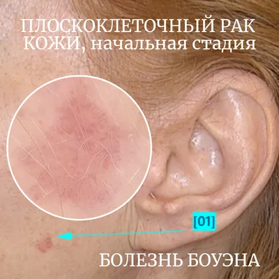 LV_doctor_cosmetology - ❗️УДАЛИТЬ НЕЛЬЗЯ ОСТАВИТЬ❗️ Базальноклеточная  карцинома - один из видов злокачественных образований кожи. Базалиома  способна к обширному местному росту, который призводит к существенным  косметическим и функциональным ...