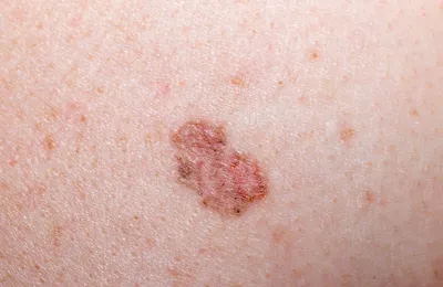 Базальноклеточный рак кожи базалиома фото фото