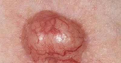 Случай №42. Плоскоклеточный рак… и, да, снова про опухоль кожи. | Сайт  дерматовенеролога Бетехтина М.С.