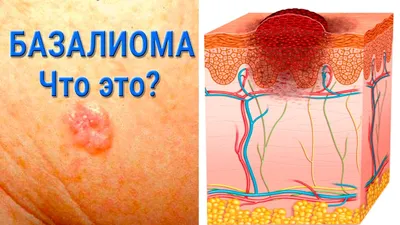 Причины и симптомы рака кожи – информационные материалы от специалистов  клиники
