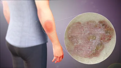 Диагностика базальноклеточного рака кожи в MyDerm | Медицинский центр MyDerm