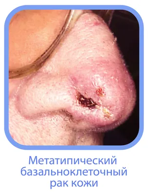 Базальноклеточный рак кожи левой бровной области / Статья на сайте  Волынской больницы от 22 апреля 2016 г.