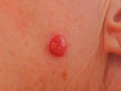 Базальноклеточный рак кожи: лечение и прогнозы при базальноклеточном раке  кожи, базальноклеточная карцинома кожи фото | Клиники «Евроонко»