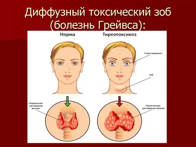 Диффузный зоб щитовидной железы - лечение в Ростове-на-Дону