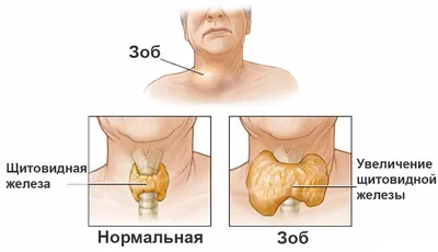 Диффузный токсический зоб — Википедия