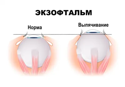 Измерение внутриглазного давления