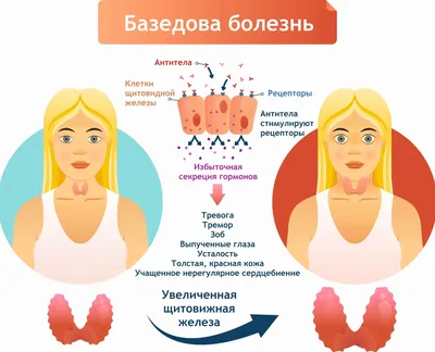 Диффузный токсический зоб | Городская клиническая больница им. Ф.И.  Иноземцева