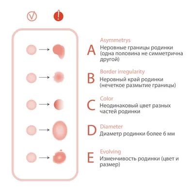 16 симптомов меланомы: что делать если нашли один?