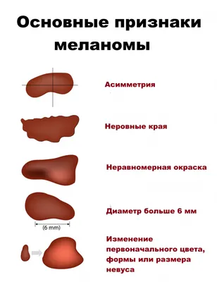 Родинки бывают разные. Врач и пациент о меланоме