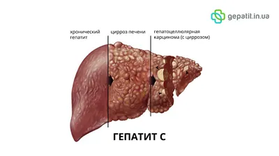 Что такое гепатит? | 17.03.2023 | Новости Улан-Удэ - БезФормата