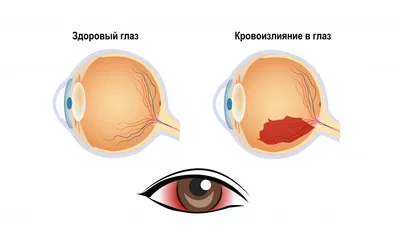 Кровоизлияние в глаз - причины появления, при каких заболеваниях возникает,  диагностика и способы лечения