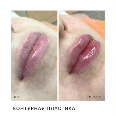 Дермальные филлеры Restylane Juvederm Radiesse | Мадрид