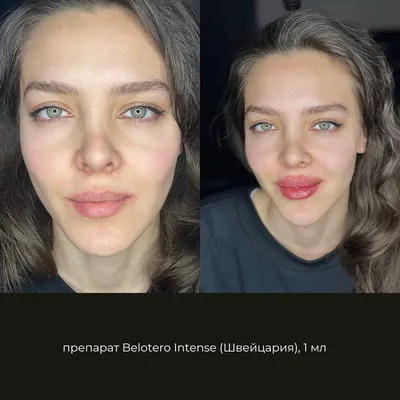 👄Коррекция губ👄 (до и... - Центр эстетической гинекологии | Facebook