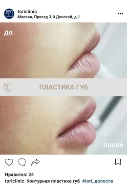 Естественное преображение губ✨⠀