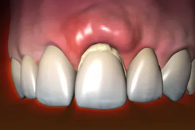 Почему возникают волнистые края у передних зубов? | Стоматология  Smile-at-Once | Дзен