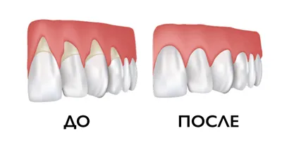 Белые пятна на зубах - что это, почему появляются, лечение и профилактика