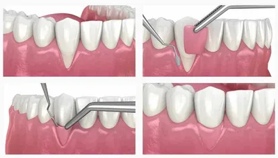 Рецессия десны — симптомы, лечение ❘ Стоматология Ортодонт Комплекс