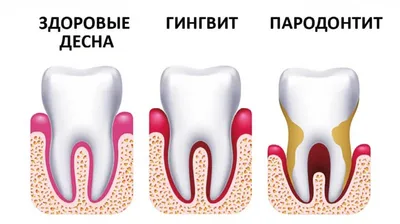 Лечение десен: перекись водорода