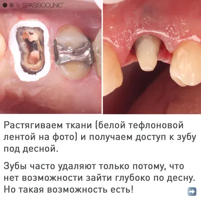 Лечение и профилактика дёсен