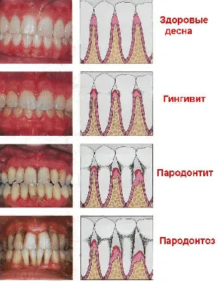 Воспалены десны, имеются белые пятна, помогите - Терапия - Стоматология для  всех