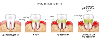 Белые шарики на десне. — 2 ответов | форум Babyblog