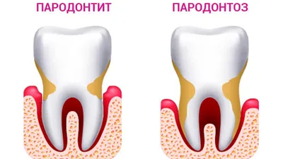 Лечение десен зубов - лечение пародонтита, лечение пародонтоза десен |  Пародонтология в Москве