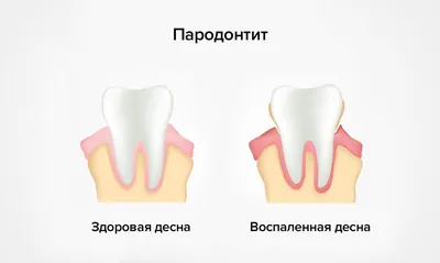 Протезы С Белыми Зубами Дентиция Десен Верхней И Нижней Челюсти Укус В  Окклюзии Изолированы На Белом Фоне Иллюстрация Вектора — стоковая векторная  графика и другие изображения на тему Без людей - iStock