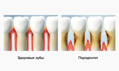 Периодонтит - опасность периодонтита, причины и симптомы, виды периодонтита