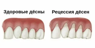 Шишка на десне: что это такое, причины и лечение — Экспертные статьи на  сайте стоматологии АРТ