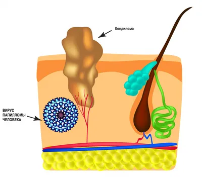 Кондиломы- причины появления, при каких заболеваниях возникает, диагностика  и способы лечения