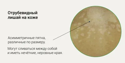 Почему на коже появляются белые пятна, как избавиться от белых пятен на  теле. Спорт-Экспресс