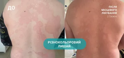 Белые точки на коже члена | Мой уролог