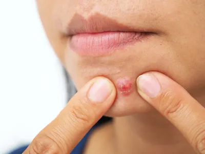 Угри на лице и коже у ребенка — причины, симптомы и лечение угревой сыпи