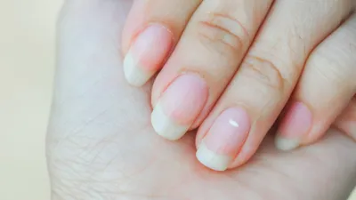 Белые пятна на ногтях: почему появляются у взрослого, что значат и как от  них избавиться