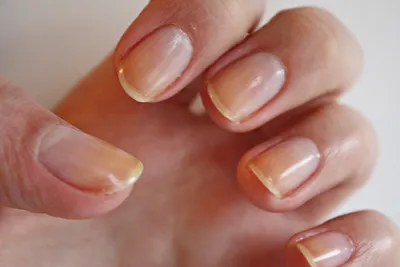 Белые пятна на ногтях: почему появляются и как избавиться | РБК Стиль
